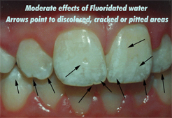 Fluorosis Chicago - Tooth