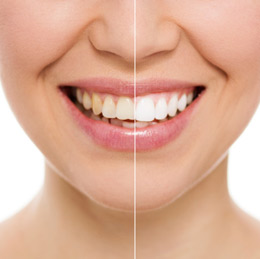 Chicago IL Teeth Whitening - Teeth Whitening