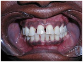 Porcelain Veneers Chicago - Before