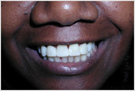 Porcelain Veneers Cost Chicago - After
