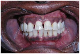 Porcelain Veneers Cost Chicago - Before