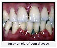 Diabetic Dental Practice Chicago - Tooth