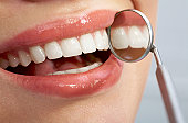 Best Veneers Chicago - Woman with smile
