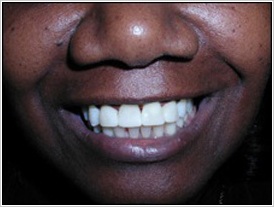 Porcelain Veneers Chicago - After