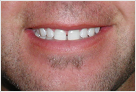 Veneers Cost Chicago - Before
