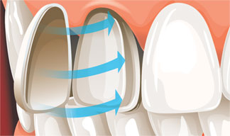 Porcelain Veneers Sacramento - Porcelain Veneers