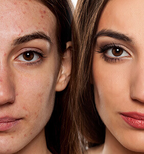Acne - Effective treatment at DermCare