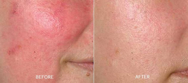 Facial Redness - Before and After image