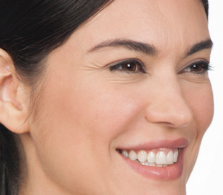 Before Botox Treatment, Case 04