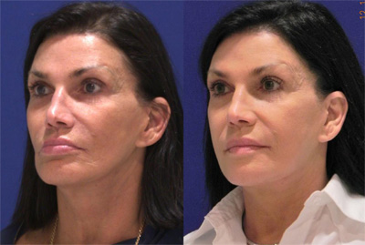 Before Sculptra, Case 11