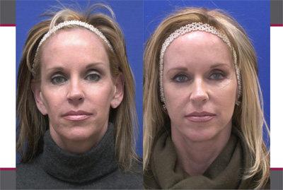 Before Sculptra, Case 08