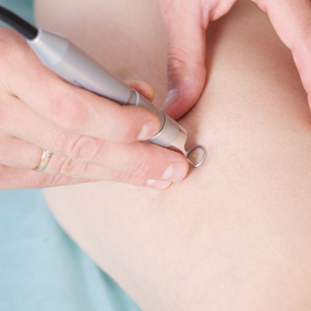 Spider Veins Medical Laser, Surgery