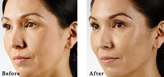 Juvederm Voluma XC Glendora - Before and After Voluma 2