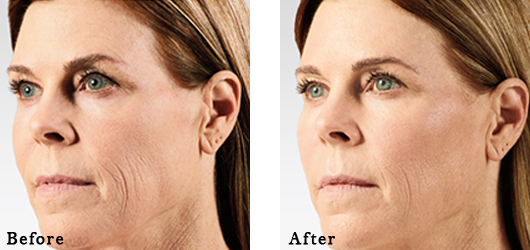 Juvederm Voluma XC Glendora - Before and After Voluma 3