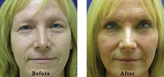 Before After Images-21