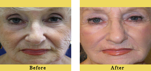Before After Images-22