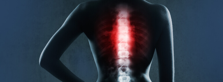 Invasive Spine Surgery