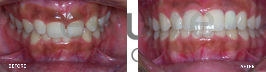 Before After Case 03