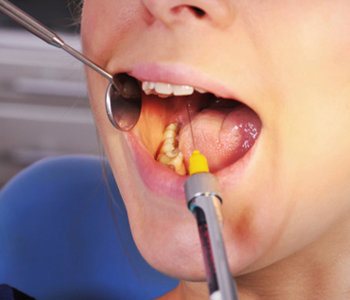 Cost and other factors of dental implants to discuss with your Scarborough dentist