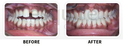 Orthodontics Before After Image 03