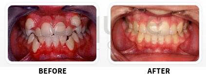 Orthodontics Before After Image 08
