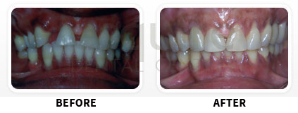 Dental Implants Before After image 03