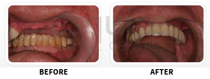 Dental Implants Before After image 07
