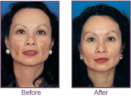 Products Franklin - Obagi Before and After Set 01