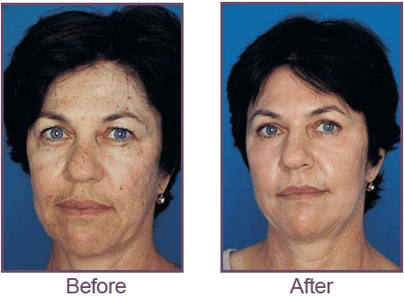 Products Franklin - Obagi Before and After Set 02