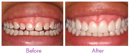 Porcelain Veneers Farmington Hills - Porcelain Veneers Before and After