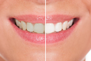 Caring for Dental Crowns Farmington Hills - Smiling Teeth