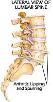 Health Risk Assessment Portland - Intervertebral disc image