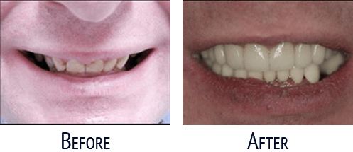 Before and After Cosmetic Dentistry 02