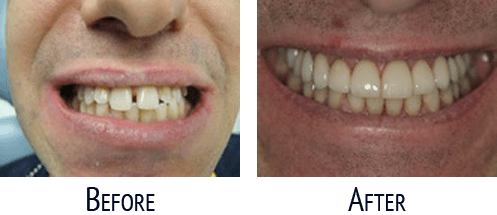 Before and After Cosmetic Dentistry 03