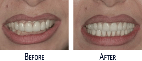 Before and After Cosmetic Dentistry 01