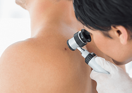 Skin Cancers