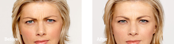 Botox Before After image 01