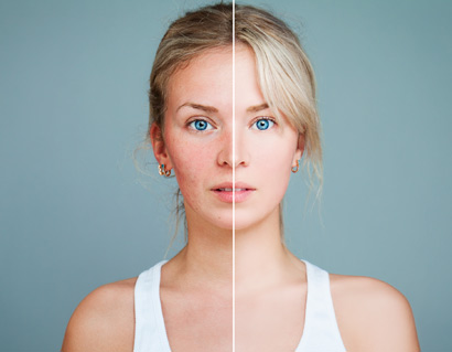 Juvederm Before After