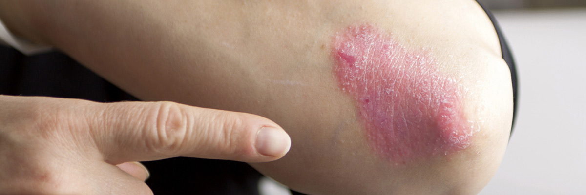 The basics of psoriasis treatment from a dermatologist in the Flower Mound, TX area