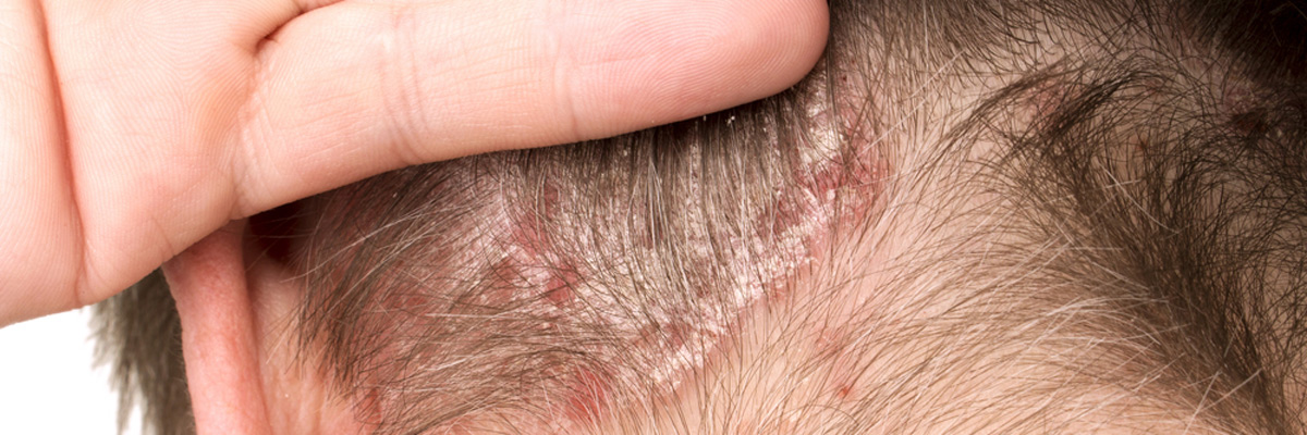Plano TX team eases psoriasis on knees by assessing type of condition responsible for discomfort, potential complications