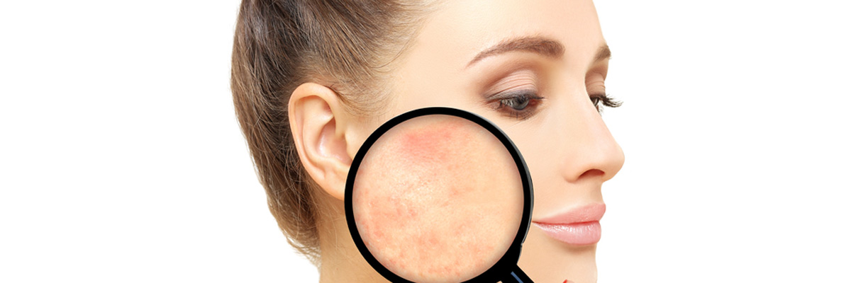 Treatment for rosacea is a phone call away to a Plano area Dermatologist