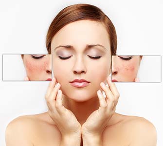 Treatment for Rosacea from Dr. Bryan Selkin