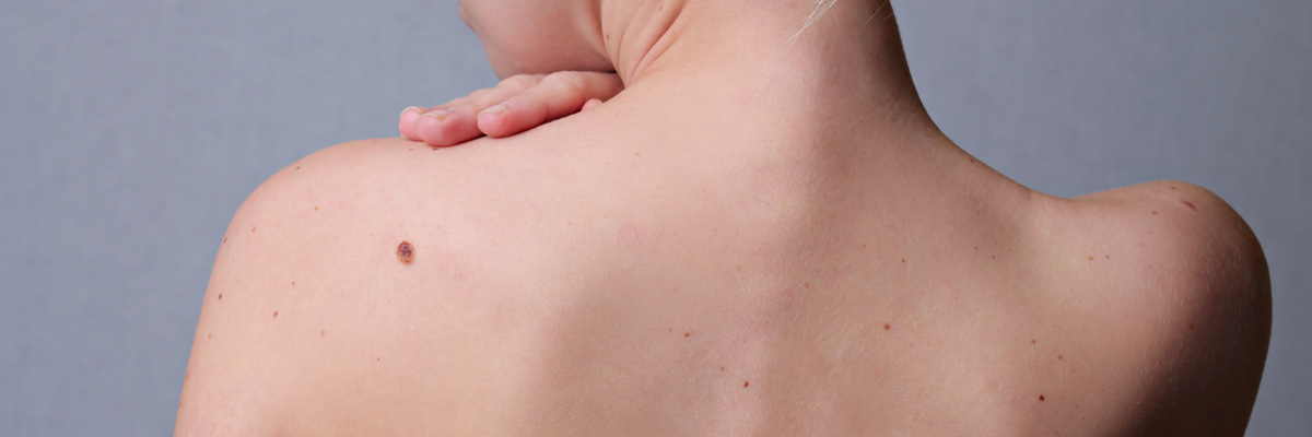 Woman with birthmarks on her back