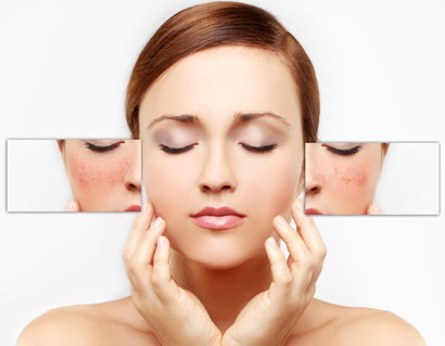 Woman with acne scarring
