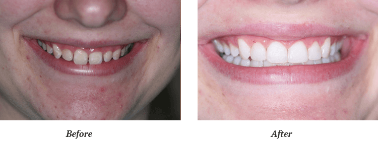 Teeth Whitening Treatment Before and After