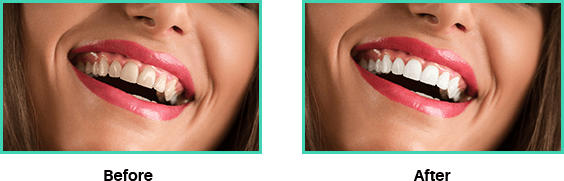 Before and after images of cosmetic dentistry