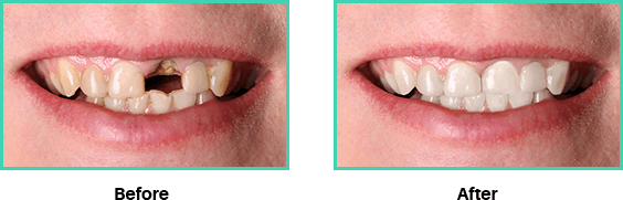 Before and after images of dental implant