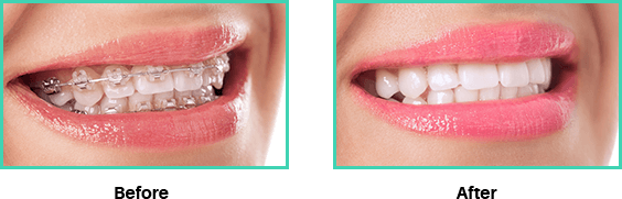 Before and after images of orthodontics procedure
