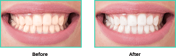 Before and after images of teeth whitening treatment