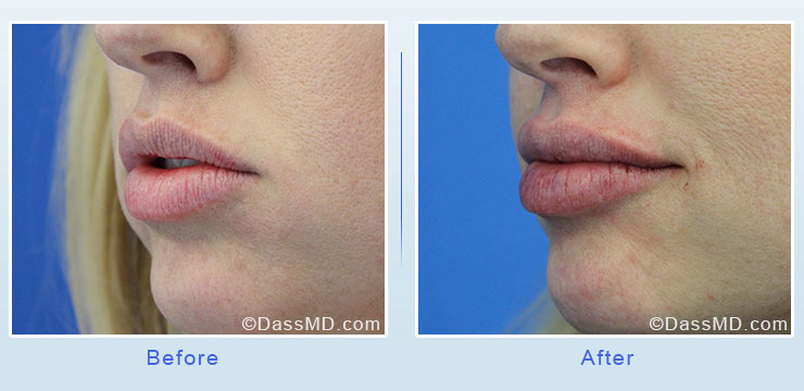 Dr Dennis Dass, MD Lips Before After Case 5